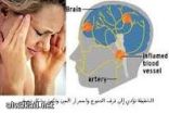 الطقس قد يتحكم بصداع الشقيقة
