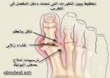 عقار جديد لعلاج النقرس لأول مرة من نصف قرن
