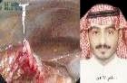 طبيب سعودي يبتكر آلة تعمل داخل بطن المريض وتحرر يد الجراح " المعطلة